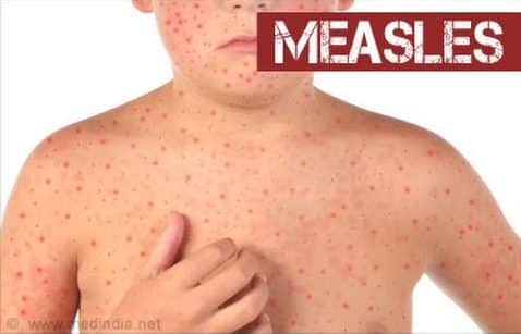 measles e1555060215417