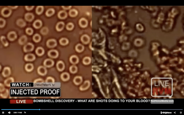 fotos beschadigde bloedcellen